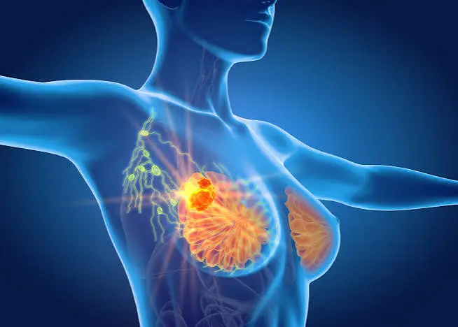 Breast cancer care